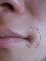 A fairly mild case of angular cheilitis extending onto the facial skin in a young person (affected area is within the black oval)