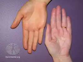 Carotenaemia