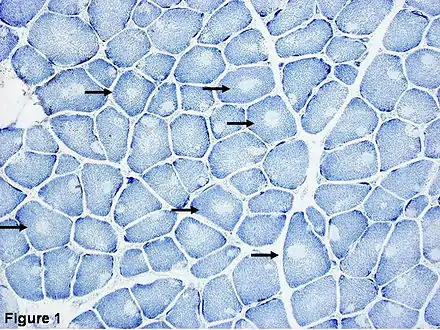 Histopathologic appearance of typical central core disease: NADH-TR, transverse section from the rectus femoris. Marked predominance of dark staining, high oxidative type 1 fibres with cores affecting the majority of fibres. Cores are typically well demarcated and centrally located (→), but may occasionally be multiple and of eccentric location.