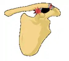 Classification type 2