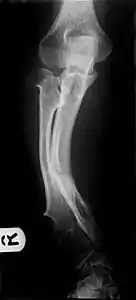 Multiple osteochondromas causing deformity of the forearm (shortening of the Radius with secondary bowing of the Ulna).