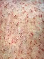 Flegel disease