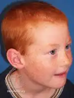 Freckles