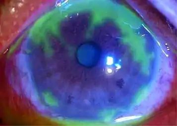 Fluorescein-stained cornea: geographic epithelial defects