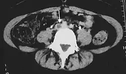 An abdominal CT scan demonstrating an iliofemoral DVT, with the clot in the right common iliac vein of the pelvis
