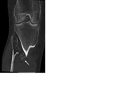 CT of osteochondroma in MO