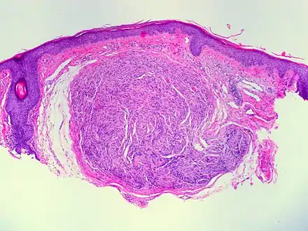 Palisaded and Encapsulated Neuroma