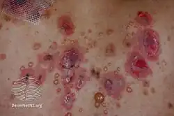 Pemphigus vulgaris