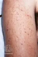 Meningococcal petechiae