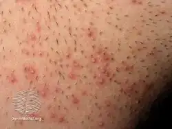 Pseudofolliculitis barbae