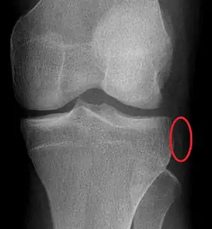 A Segond fracture seen on X-ray