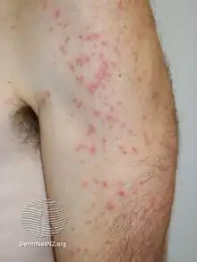 Swimmers itch