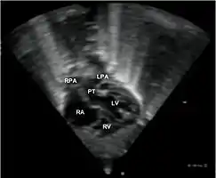 Echocardiogram in transposition of the great arteries. This subcostal view shows the left ventricle giving rise to a vessel that bifurcates, which is thus identified as the pulmonary artery.Abbreviations: RA=right atrium, RV=right ventricle, LV=left ventricle, PT=pulmonary trunk, LPA and RPA=left and right pulmonary artery.